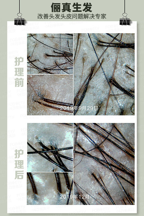 頭油、頭癢