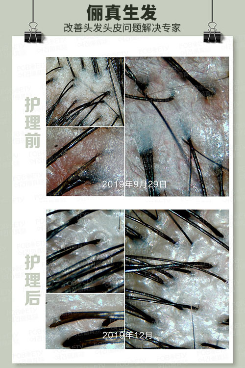 頭油、頭癢