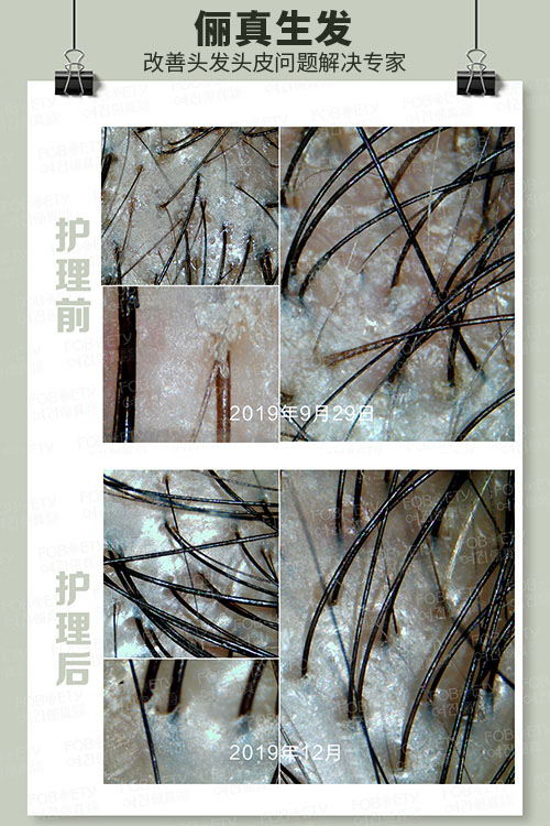 頭油、頭癢